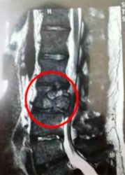 Kanser Tulang Belakang Gejala Pertama