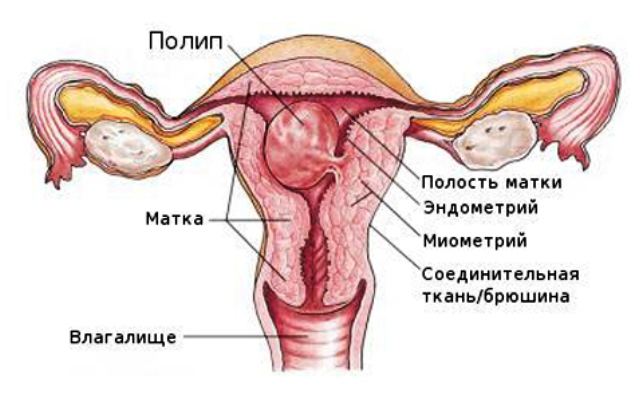 Polipo endometriosis